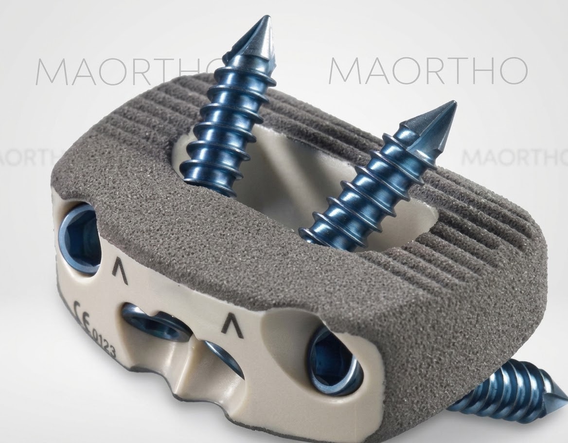 Cervical PEEK Cage with Integrated Screws